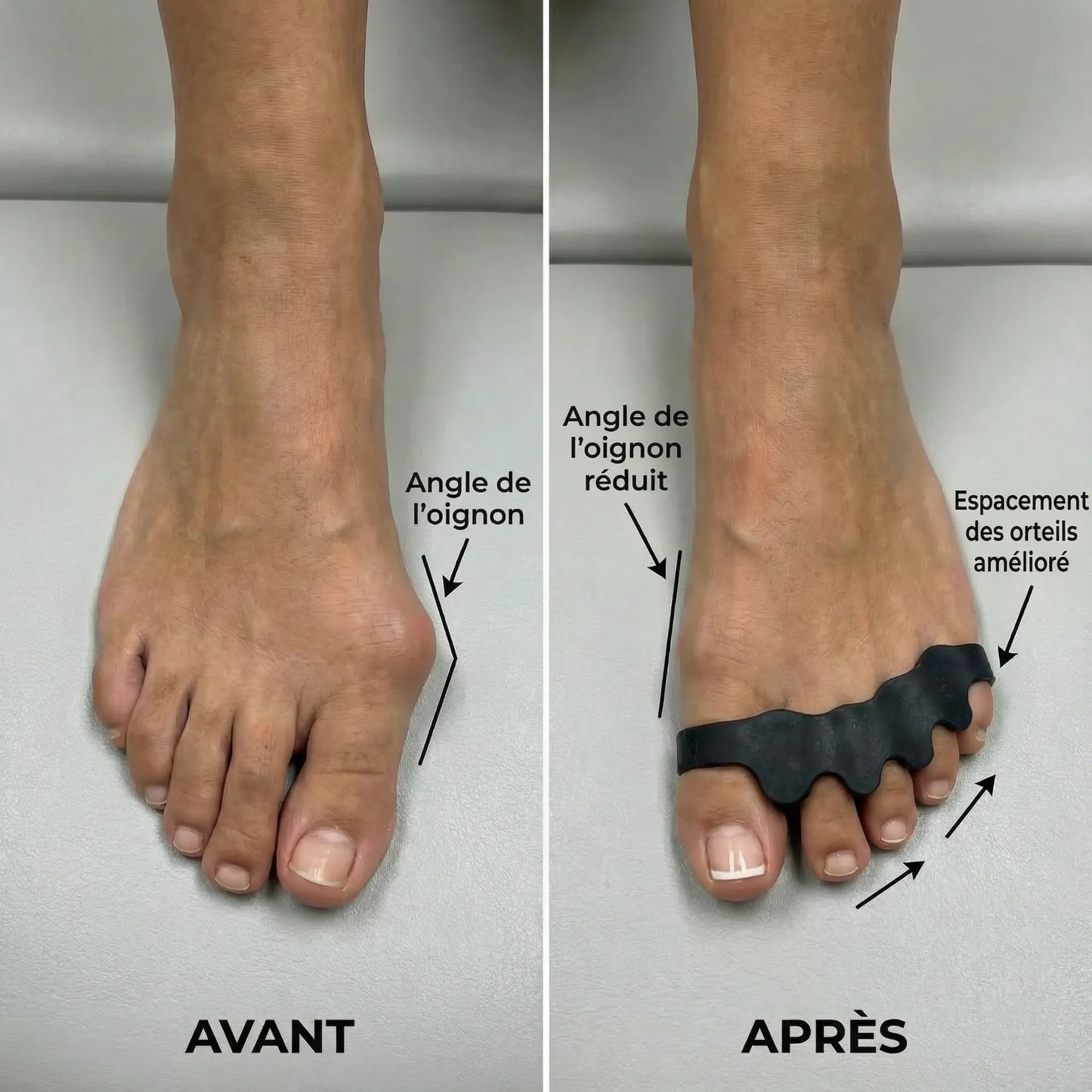 OrthoStep™ — Séparateur d’orteils en silicone de grade médical